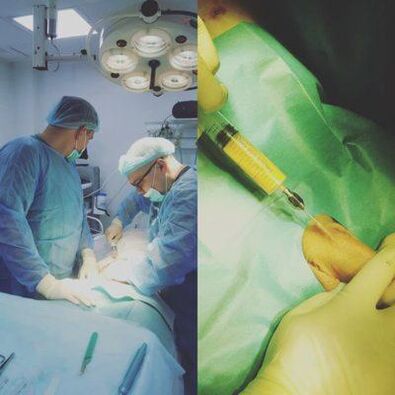 Penebalan zakar adalah mungkin dengan bantuan pembedahan